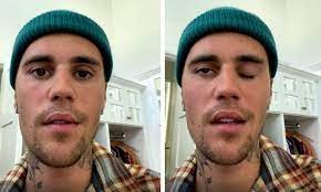 American singer Justin Bieber shares update of his facial recovery treatment